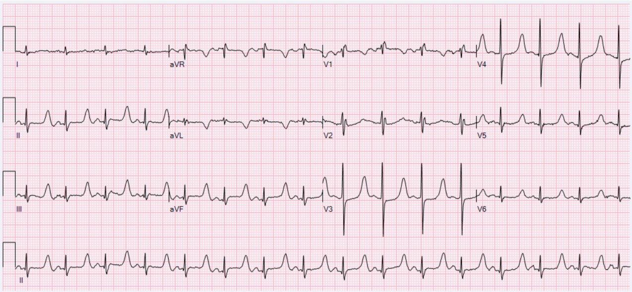 Patient Monitoring